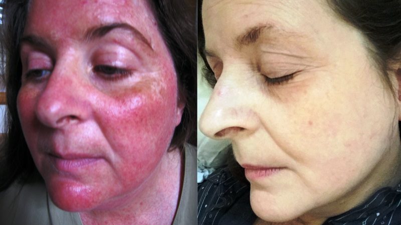 8 Home Remedies For Rosacea And Its Symptoms