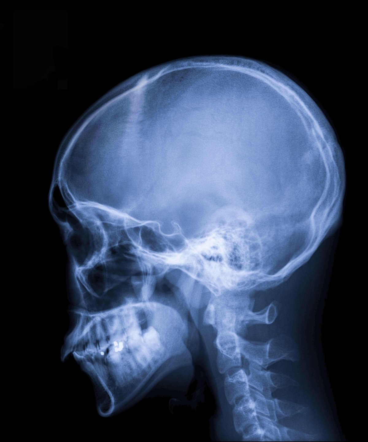 Hard Knocks: The Strange And Unpredictable Nature Of Concussions